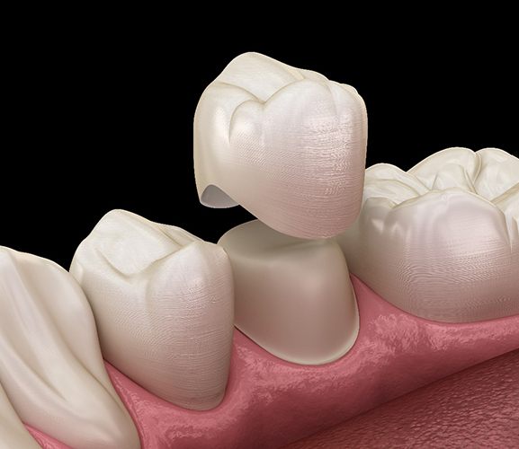 A 3-D illustration of dental crowns in Dallas
