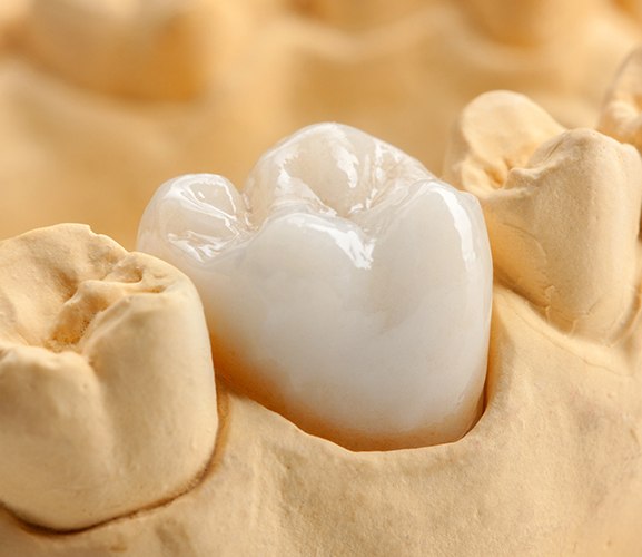 Model smile with dental crown restoraitve dentistry