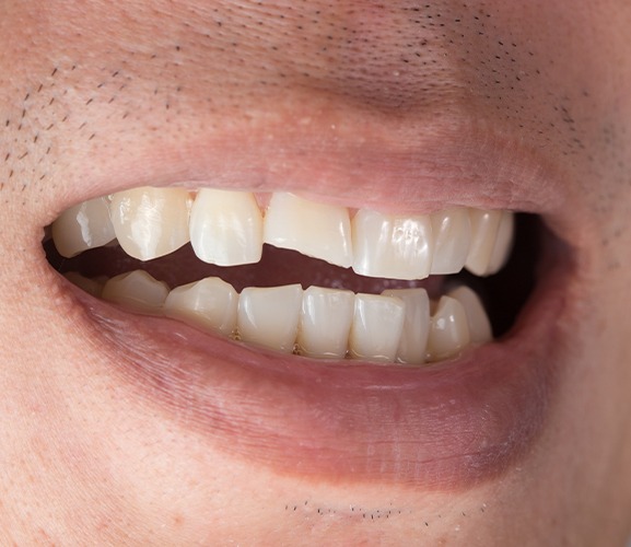 Closeup of smile with chipped front tooth before one visit dental restorations