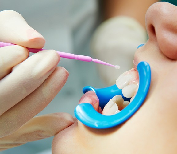 Patient receiving silver diamine fluoride treatment