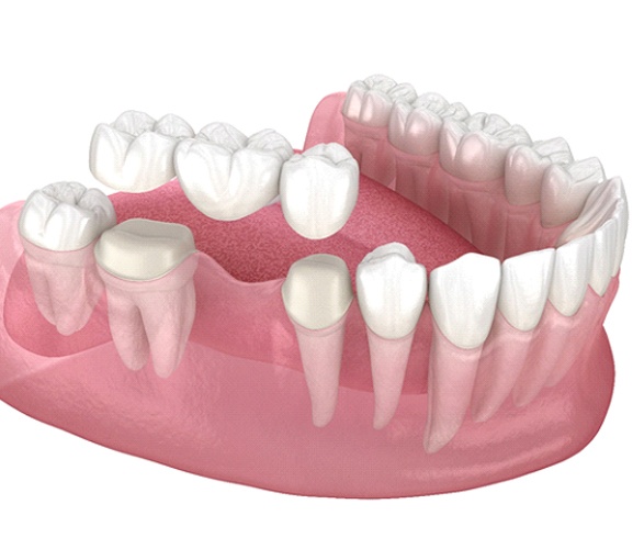 Diagram of a dental bridge in Dallas