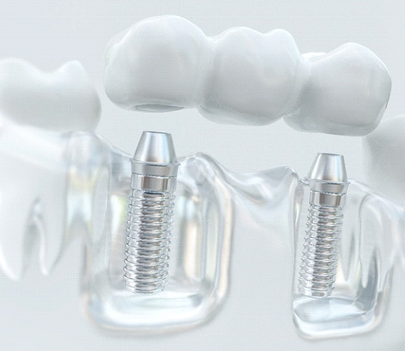 Diagram of an implant bridge in Dallas