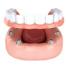 Illustration of implant denture being secured on lower arch