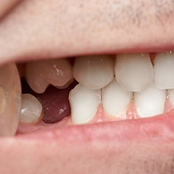 Close-up of a missing tooth