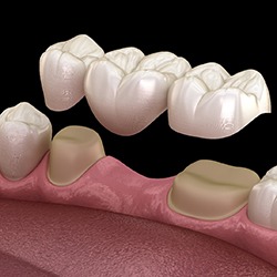 Digital illustration of a dental bridge