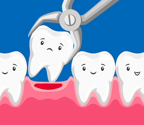 illustration of tooth extraction in Dallas