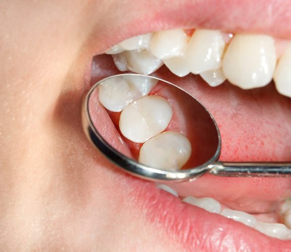 woman smiling with tooth-colored fillings in Dallas 