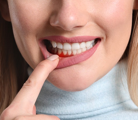 A closeup of a woman’s red and inflamed gum tissue