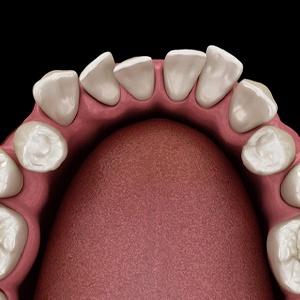 Diagram of crowded teeth in Diagram before Invisalign