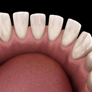 Diagram of spaces between teeth in Dallas before Invisalign