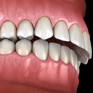 Diagram of overbite in Dallas before Invisalign