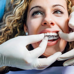 Dentist inserting Invisalign over patient’s upper arch