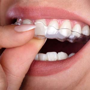 person putting an Invisalign aligner over their teeth