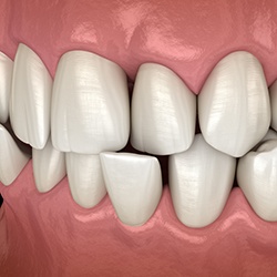 Illustration of a crossbite