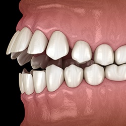 Illustration of an open bite
