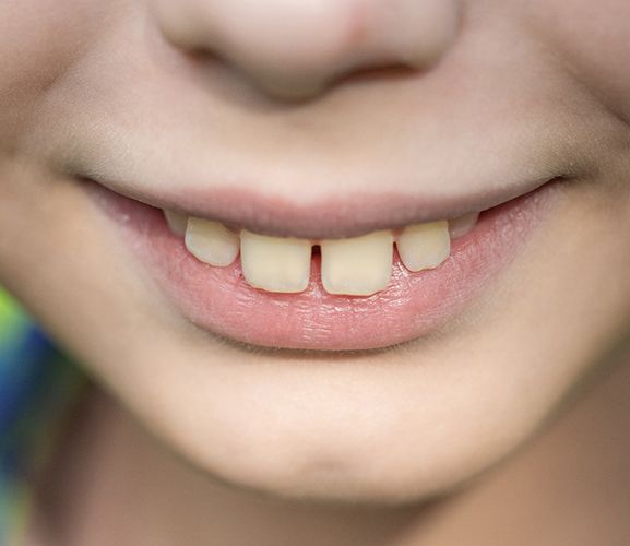 Up-close view of an overbite and gapped teeth