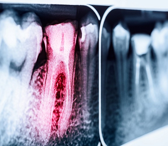 An X-ray of an infected tooth
