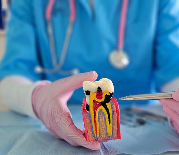 A dentist showing a model of an infected tooth