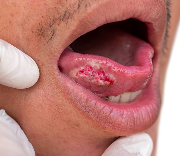 Closeup of oral cancer on the tongue