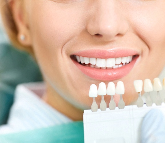 Shade guide next to patient’s teeth, showing results of whitening treatment