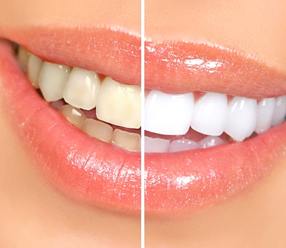 Close-up of teeth before and after whitening treatment