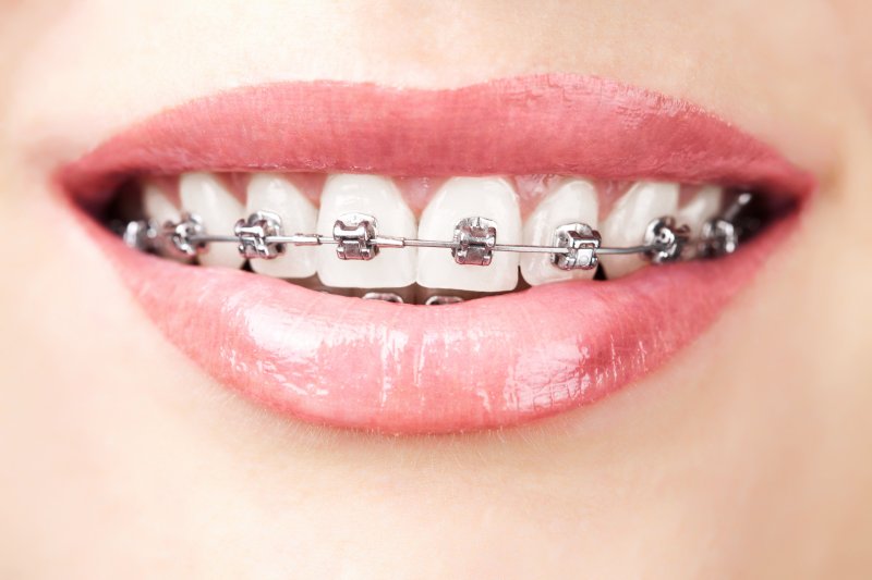 woman smiling while wearing traditional braces