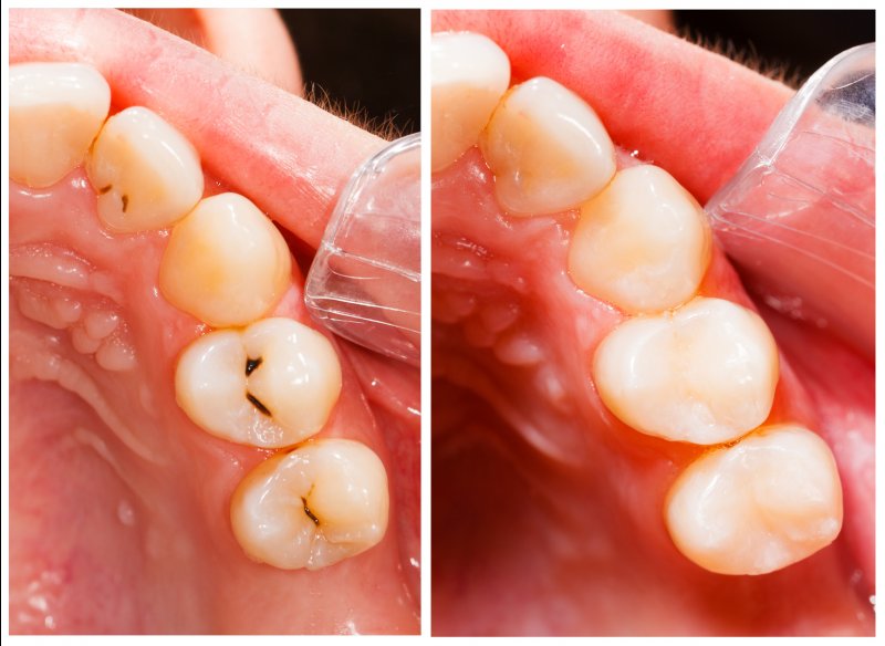 close-up of a dental filling