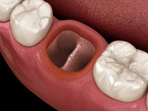 Illustration of a dry socket after tooth extraction