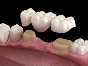3D render of a dental bridge
