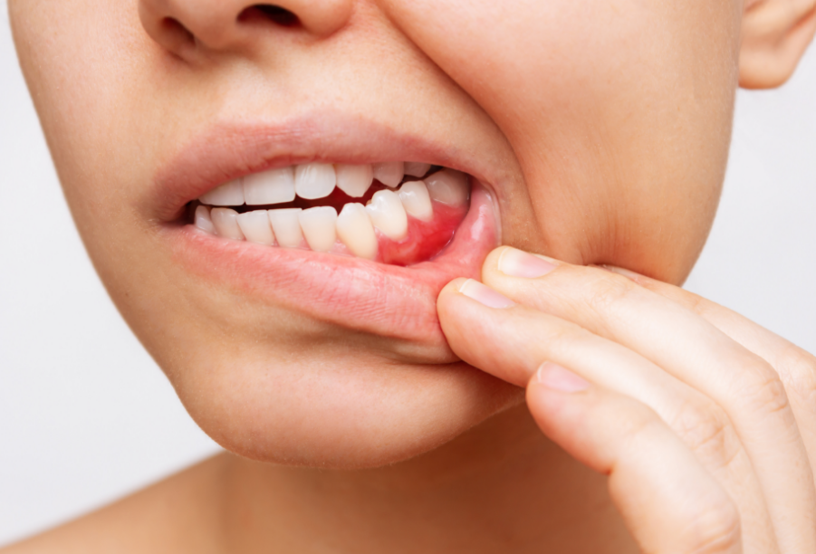 Woman showing inflammed gums